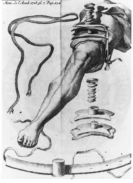 Torniquete de pierna del siglo XVIII.